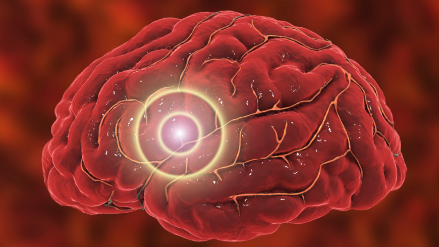Det er teorier om at hjernestammen og trigeminusnerven er innblandet.  Foto: Shutterstock